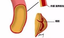 一根血管下的生命
