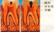 什么是龋齿，龋病是怎么发生的？