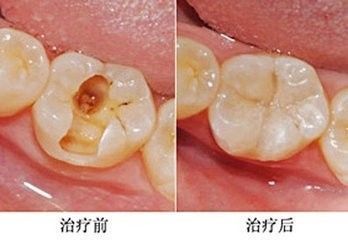 牙齿上的组成：填充牙齿_200字