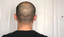 痂 第二回_3000字