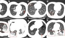 关于新型冠状病毒肺炎作文：新型冠状病毒的传染途径是什么？_200字