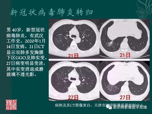 关于新的冠状动脉病毒肺炎组成：新冠状动脉病毒疫情第三篇_1200字