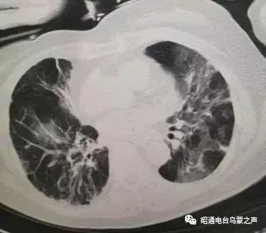 关于新的冠状动脉病毒肺炎组成：新的冠状动脉肺炎体验文章四_1200字