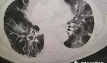 关于新型冠状病毒肺炎作文：新型冠状肺炎心得体会篇四_1200字